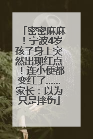 密密麻麻！宁波4岁孩子身上突然出现红点！连小便都变红了……家长：以为只是摔伤